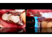 Detalles para evitar complicaciones en la prótesis fijas sobre implantes