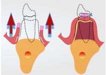 Protocolo de Incisiones en Cirugía Oral para una Regeneración Ósea  Exitosa